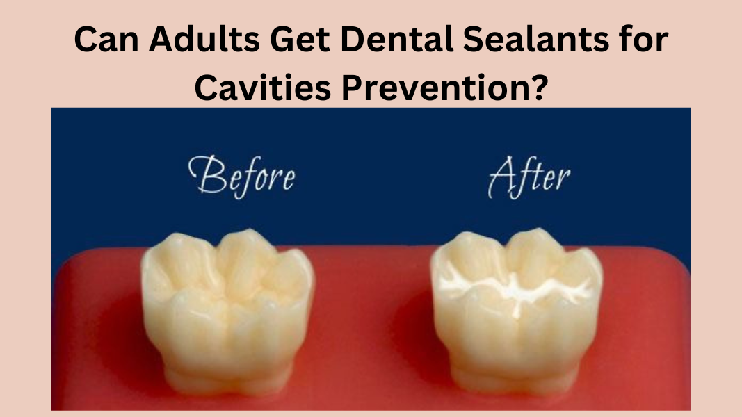 Can Adults Get Dental Sealants for Cavities Prevention?