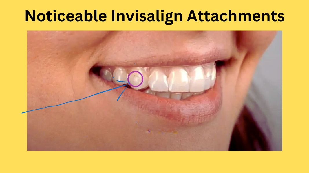 Noticeable Invisalign Attachments?