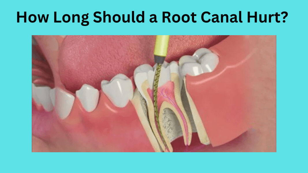 How Long Should a Root Canal Hurt?