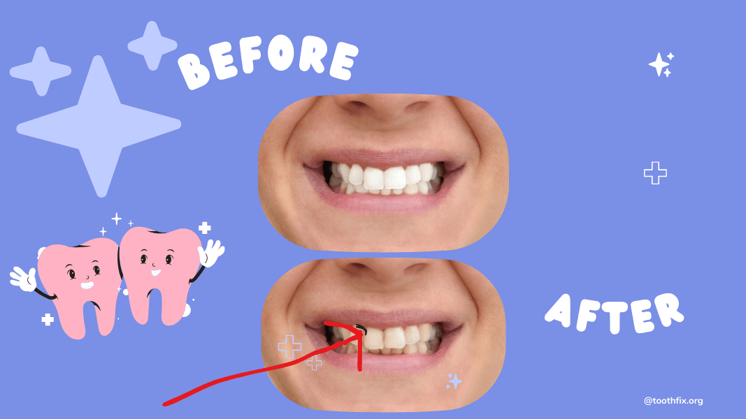 CAN YOU GET CAVITIES IN FRONT TOP & BOTTOM TEETH?