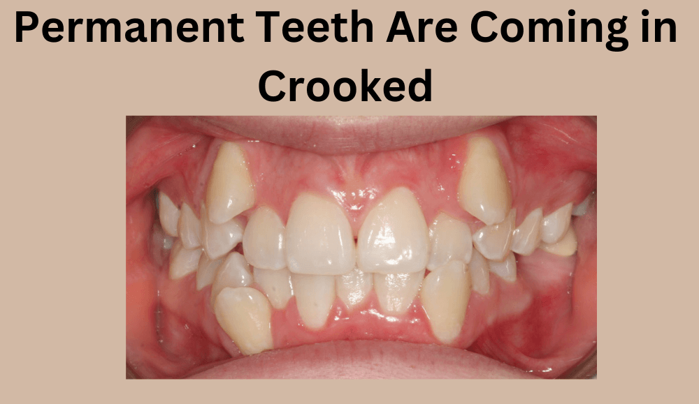 What to Do If Permanent Teeth Are Coming in Crooked?